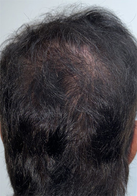 hair transplant before after Photos