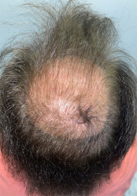 hair transplant before after Photos