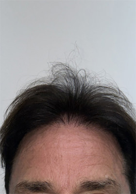 hair transplant before after Photos