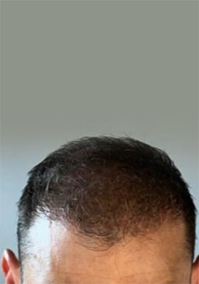 hair transplant before after Photos