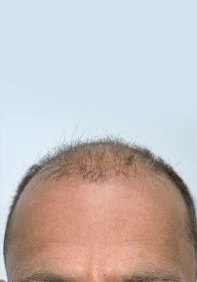 hair transplant before after Photos