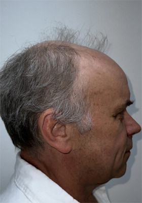 hair transplant photos