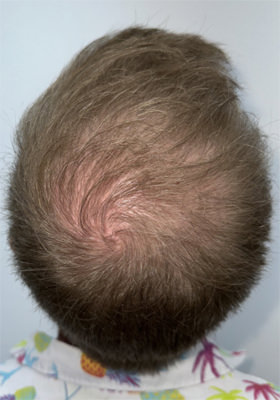 hair transplant before after Photos