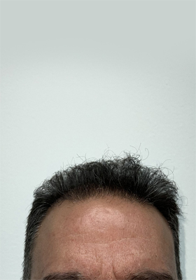 hair transplant before after Photos