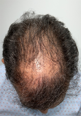 hair transplant before after Photos