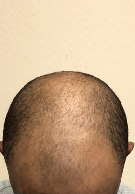 hair transplant before after Photos