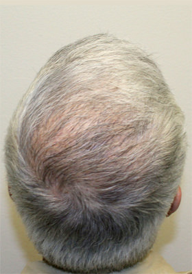 hair transplant before after Photos