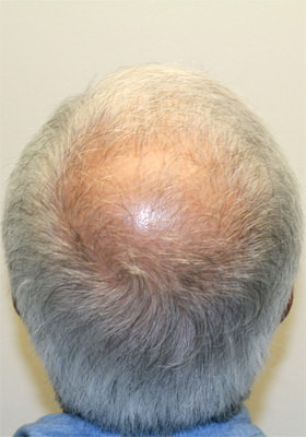 hair transplant before after Photos