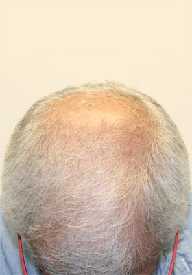 hair transplant before after Photos