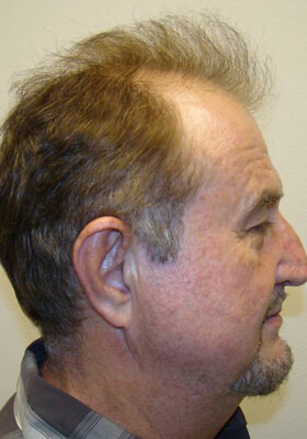 hair transplant photos