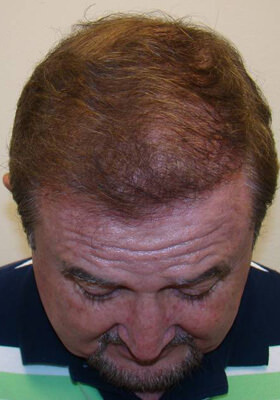 hair transplant before after Photos