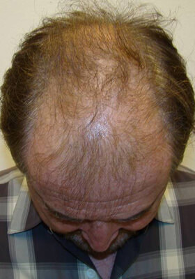 hair transplant before after Photos