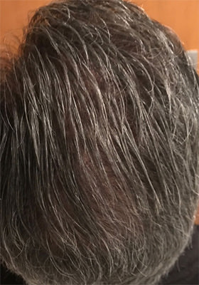 hair transplant photos