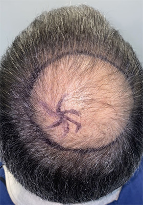 hair transplant photos