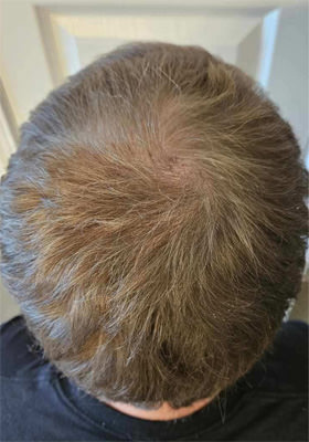 hair transplant photos