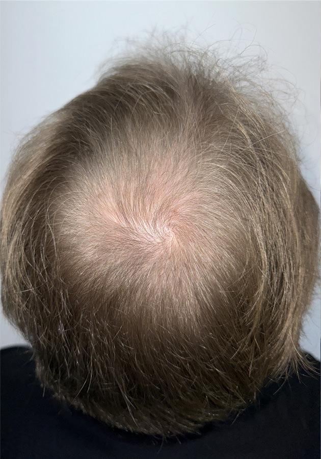 hair transplant photos