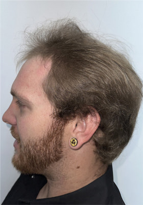 hair transplant photos