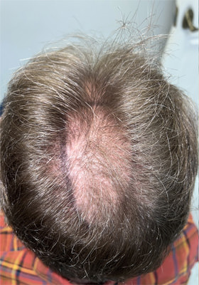 hair transplant before after Photos