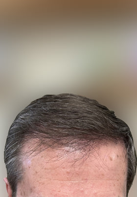 hair transplant before after Photos