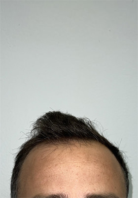 hair transplant before after Photos