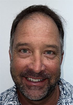 hair transplant photos