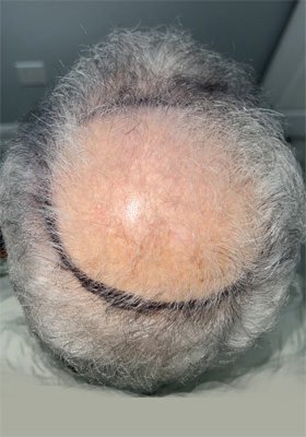 hair transplant before after Photos