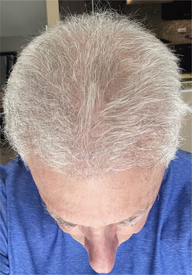 hair transplant photos