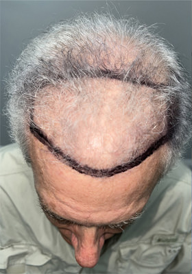 hair transplant photos