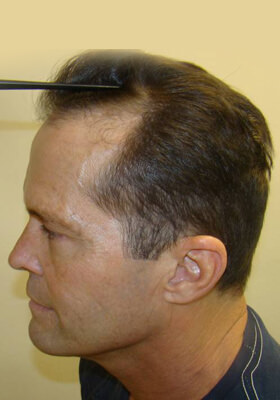 hair transplant photos