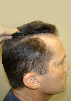 hair transplant photos