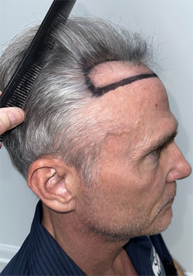 hair transplant photos