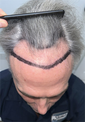 hair transplant before after Photos