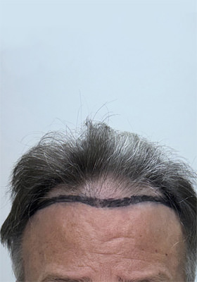 hair transplant before after Photos