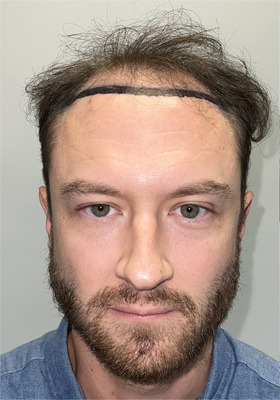 hair transplant photos