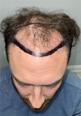 hair transplant photos