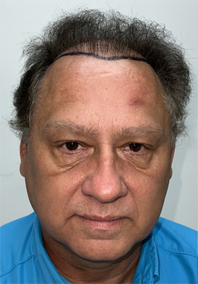 hair transplant before after Photos