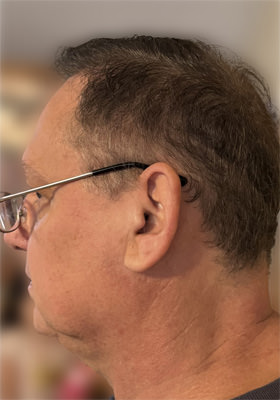 hair transplant photos