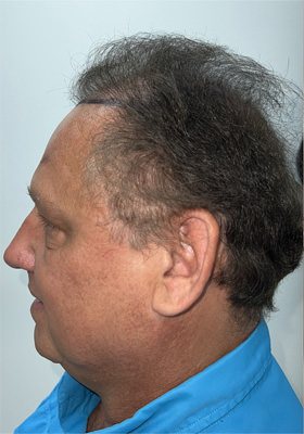 hair transplant photos