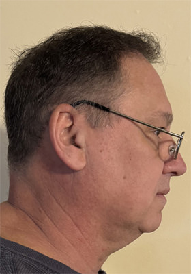 hair transplant before after Photos