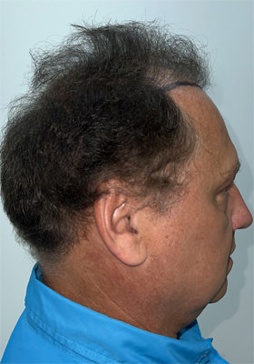 hair transplant photos