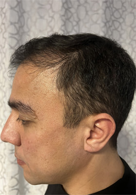 hair transplant photos