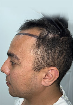 hair transplant before after Photos