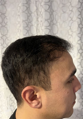 hair transplant photos