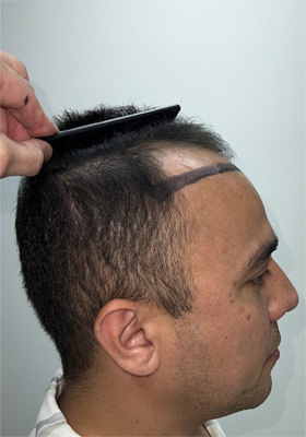 hair transplant photos