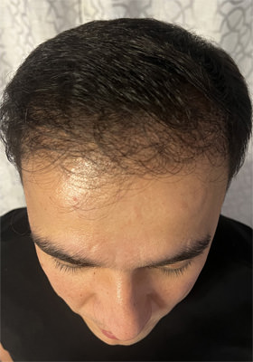 hair transplant before after Photos