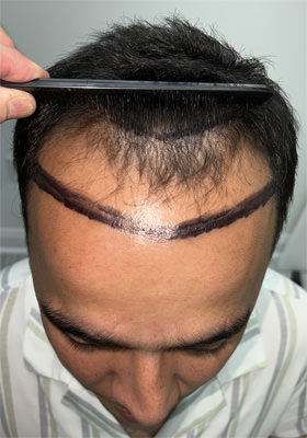 hair transplant photos