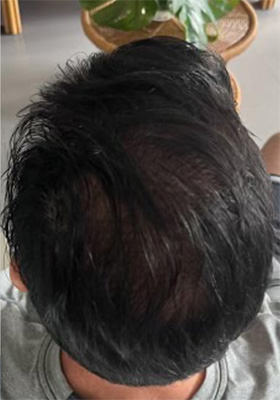 hair transplant photos