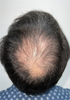 hair transplant before after Photos