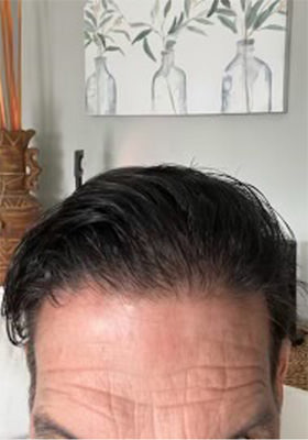 hair transplant before after Photos