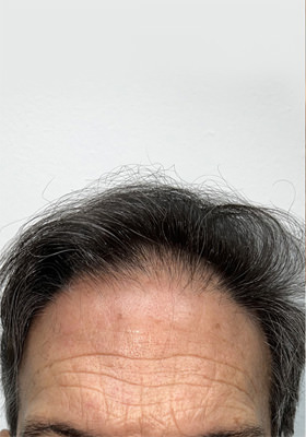 hair transplant photos